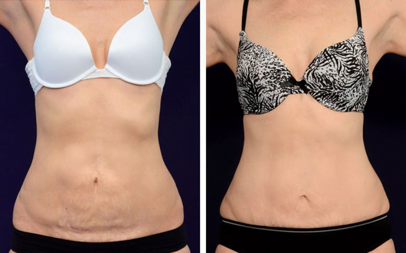 Tummy Tuck Guide All You Need To Know