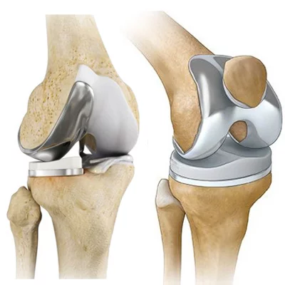 Knee Replacement Surgery Guide The More Clinics