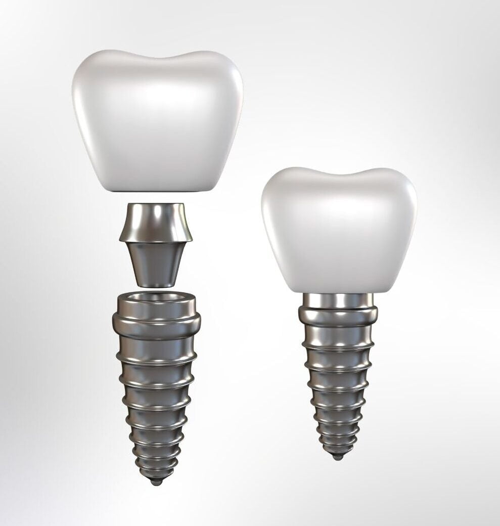 Dental Implants Turkey Cost The More Clinics Best Choice