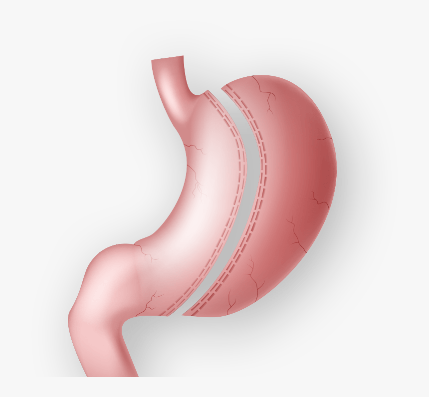 Gastric Sleeve Turkey - The More Clinics