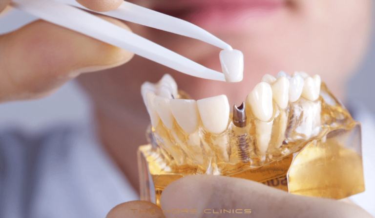 Dental Implants With Bone Loss