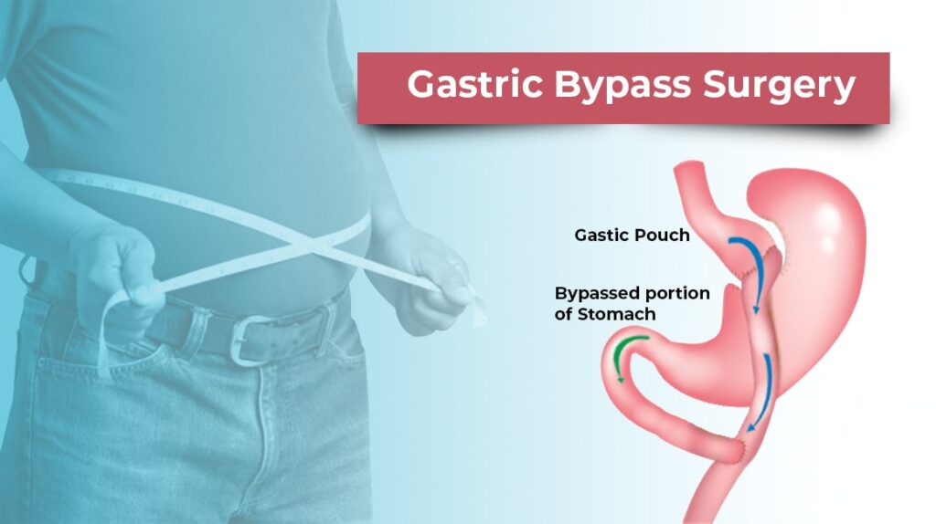 9 Reason To Think About Gastric Bypass Surgery The More Clinics