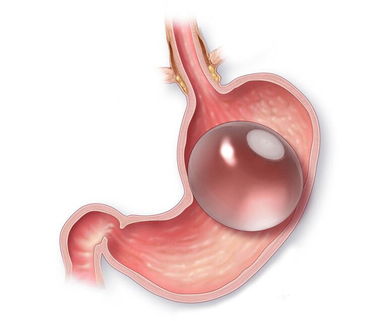 Gastric Balloon Turkey: The Day of Procedure