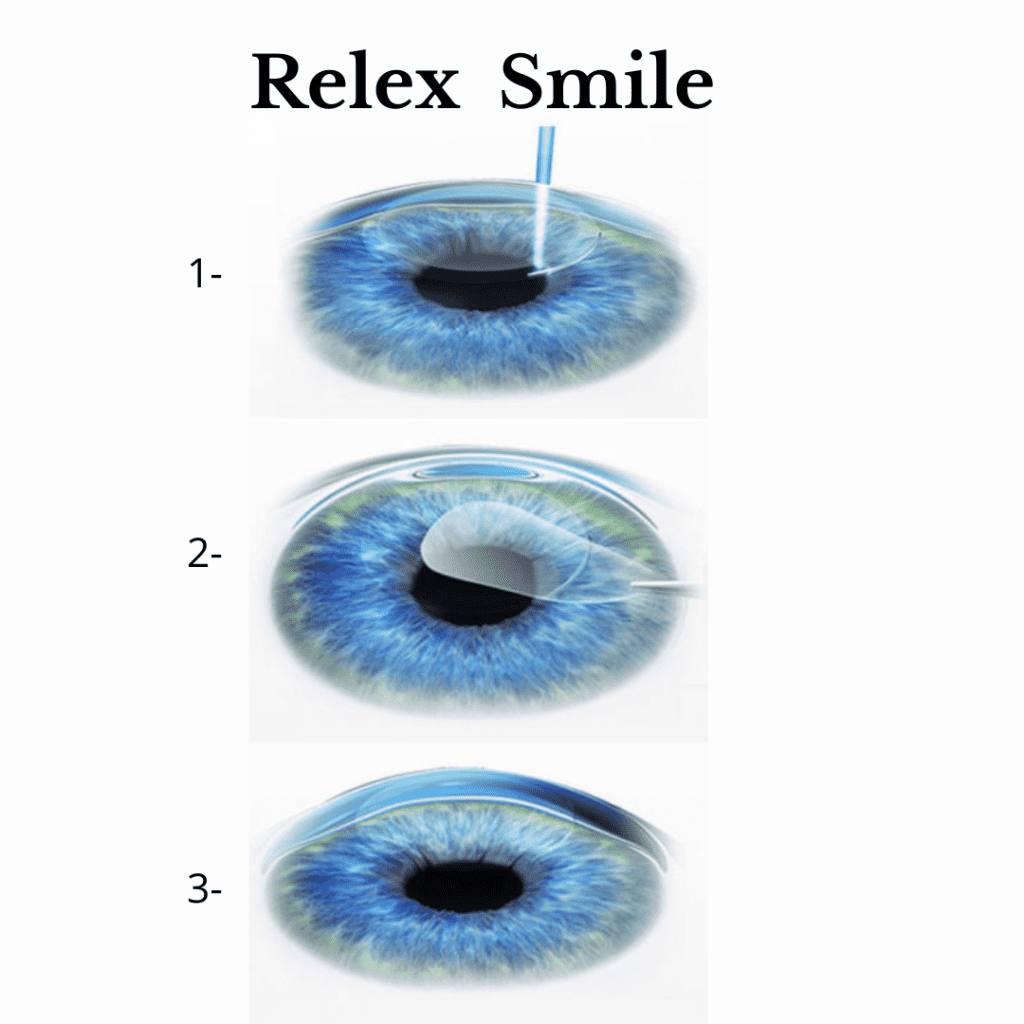 ReLEX SMILE Laser Eye Surgery - The More Clinics