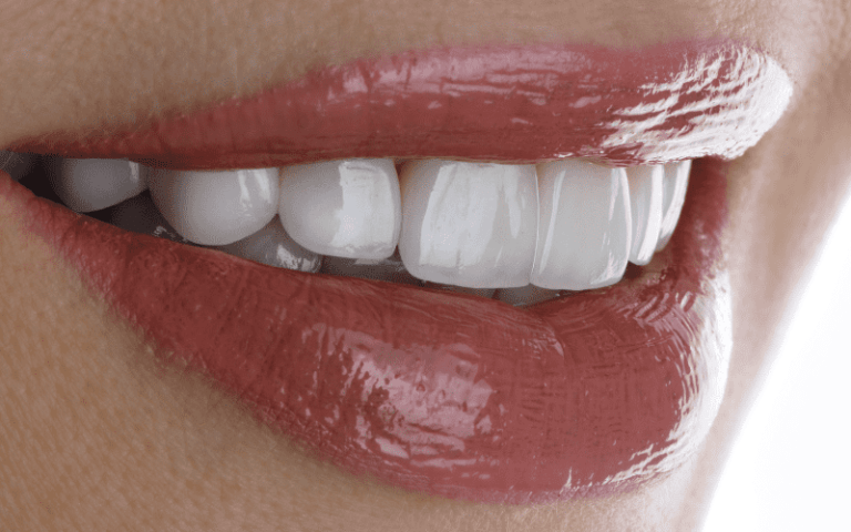 Composite Veneers – Composite Bonding Turkey