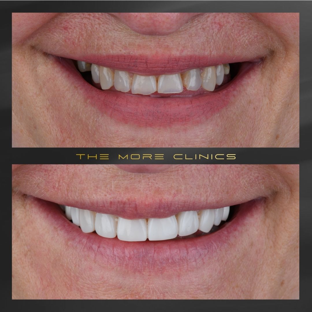 Composite Bonding Turkey - Your Guide to Composite Veneers