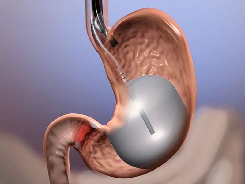 Antalya gastric balloon