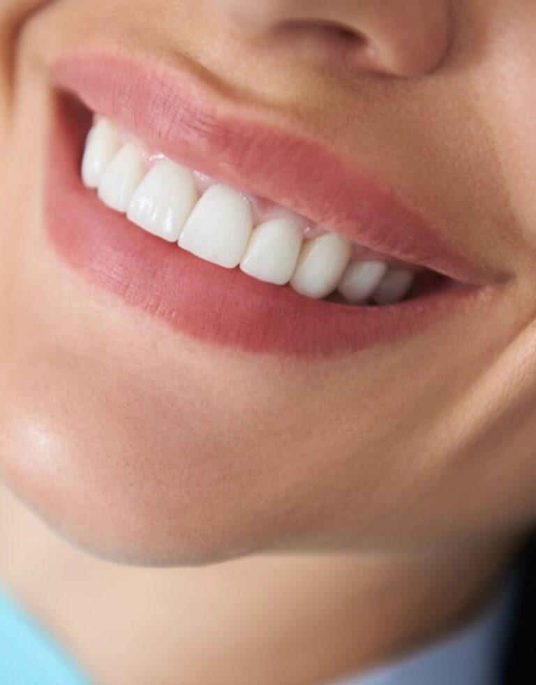 Types of Dental Veneers