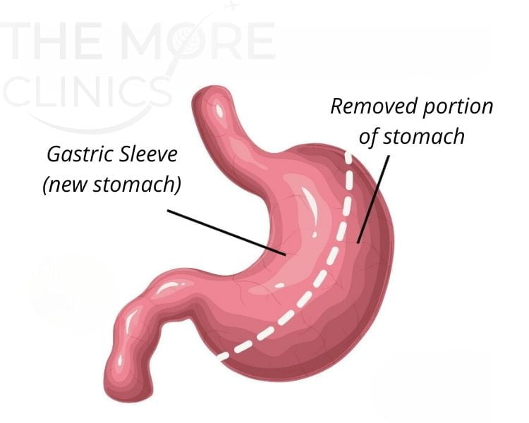 Gastric Sleeve Cost Turkey