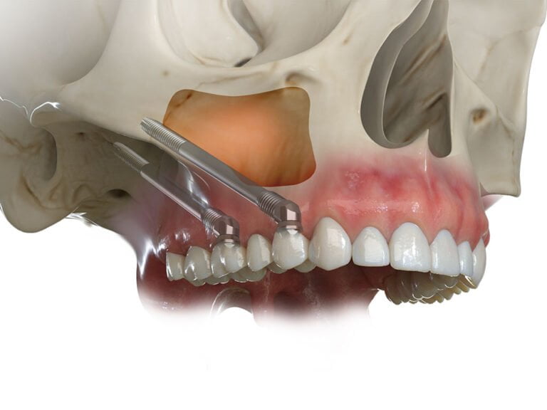 Zygomatic Implants (Cheekbone Implants) - The More Clinics