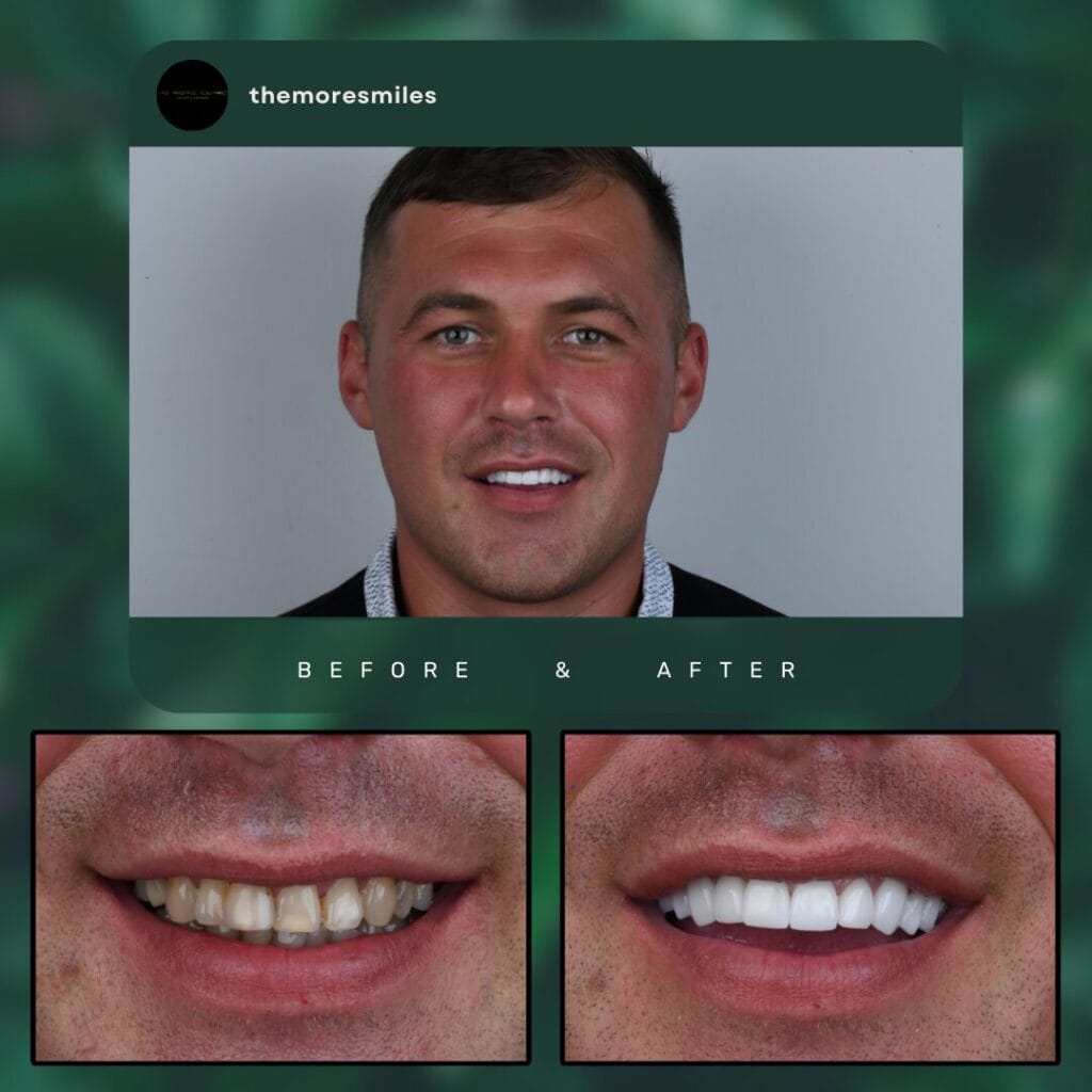 dental veneers turkey before and after