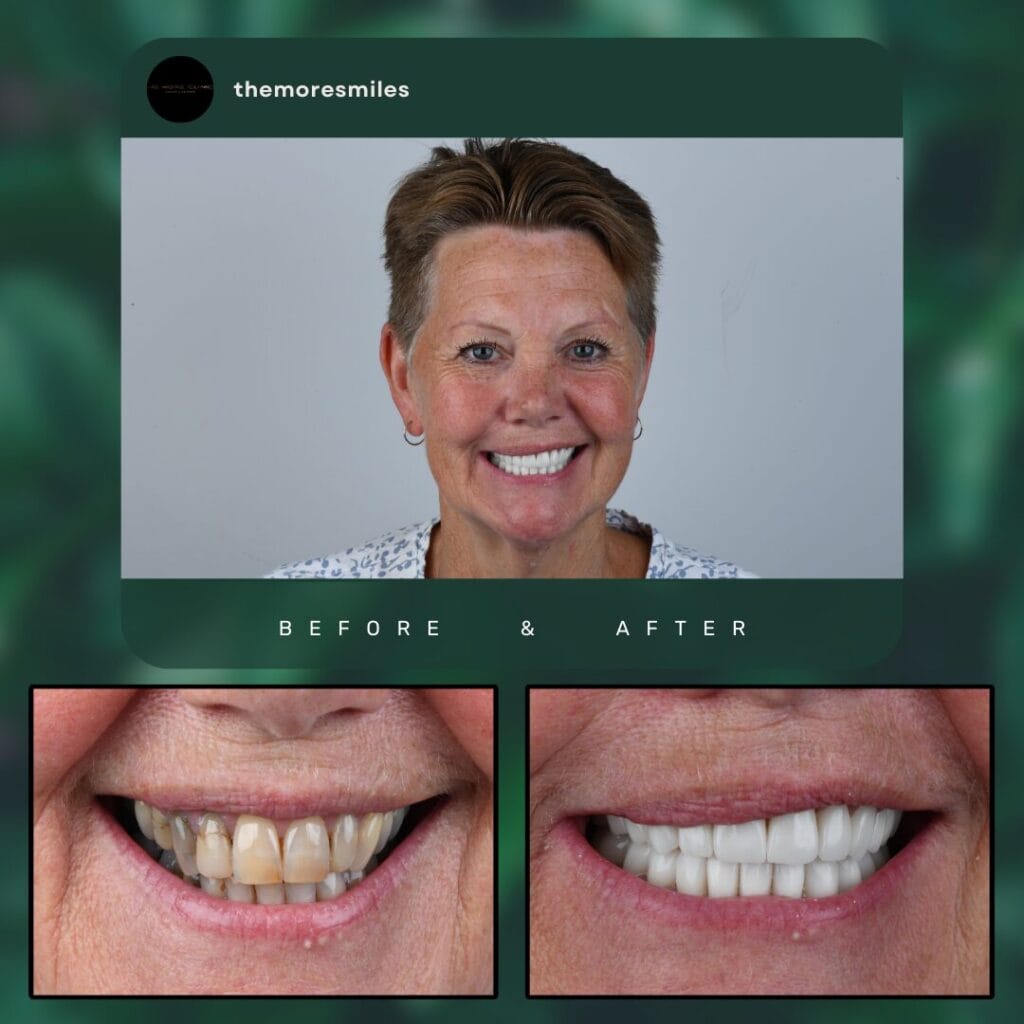 veneers cost turkey​