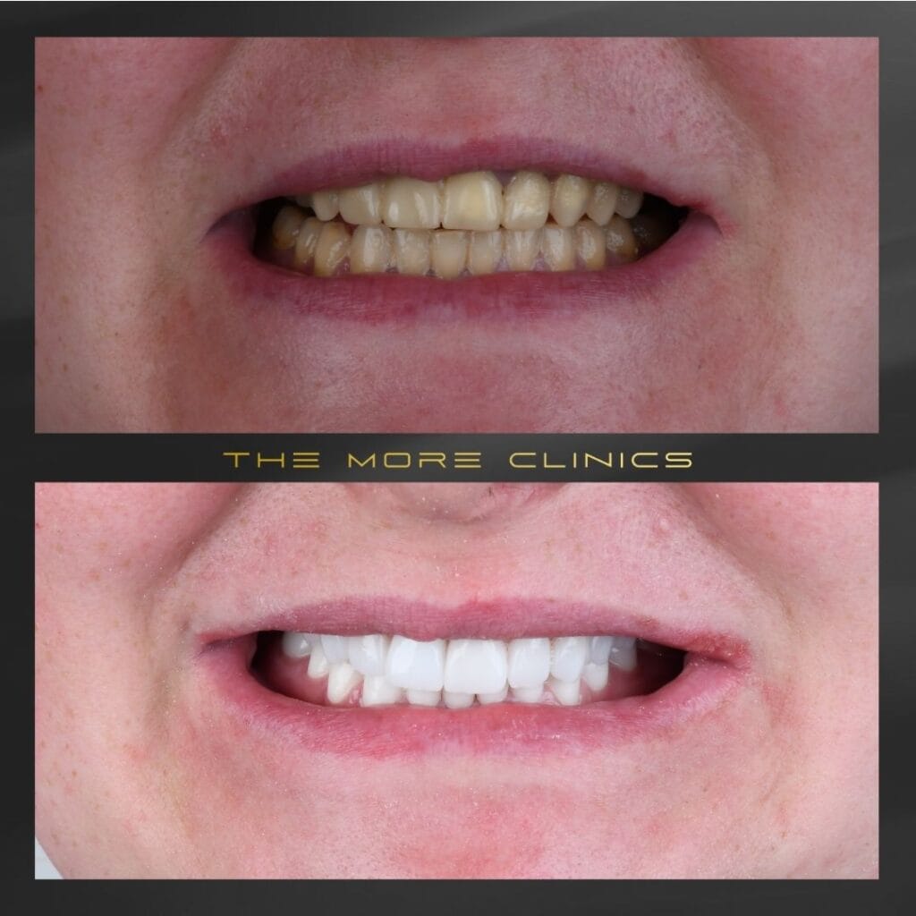 before and after dental veneers turkey