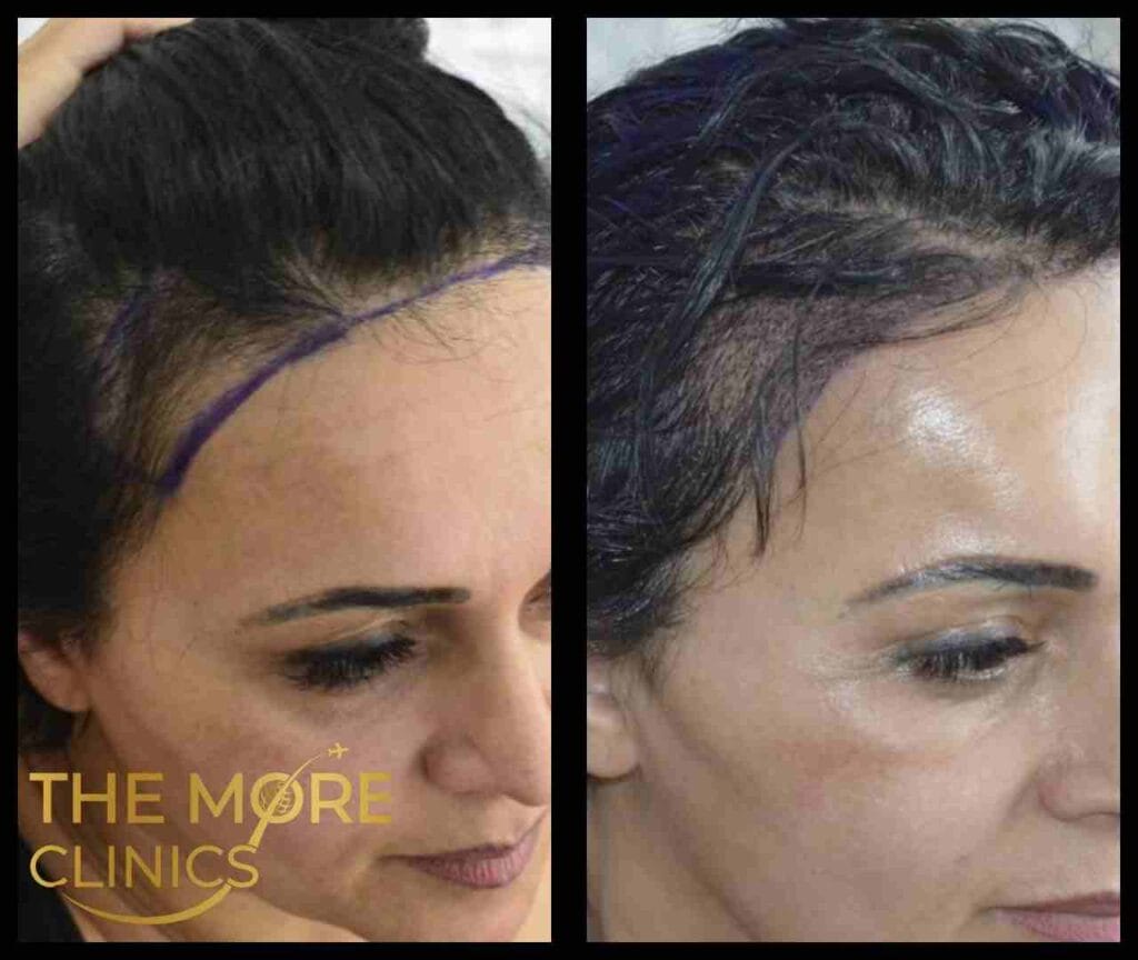 haartransplantation frauen​ vorher nachher