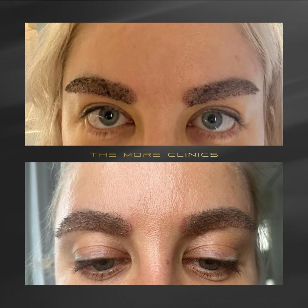 eyebrow transplant before after result