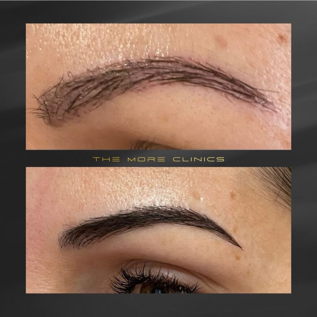 eyebrow transplantation antalya turkey