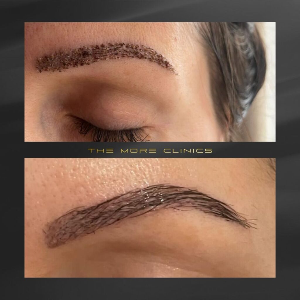 turkey antalya eyebrow transplant before and after